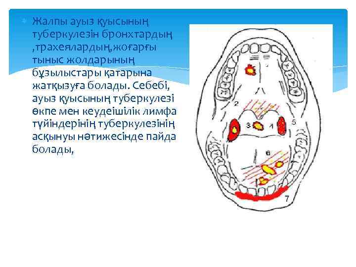  Жалпы ауыз қуысының туберкулезін бронхтардың , трахеялардың, жоғарғы тыныс жолдарының бұзылыстары қатарына жатқызуға