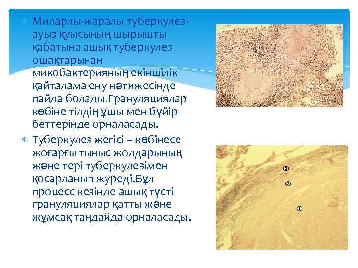  Миларлы-жаралы туберкулезауыз қуысының шырышты қабатына ашық туберкулез ошақтарынан микобактерияның екіншілік қайталама ену нәтижесінде