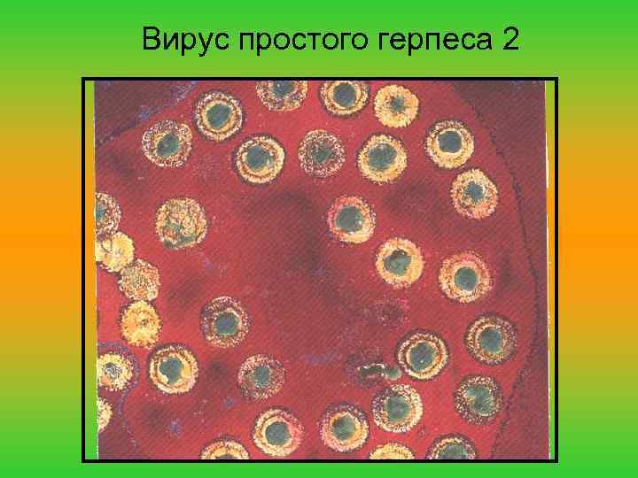 Вирус простого герпеса 2 