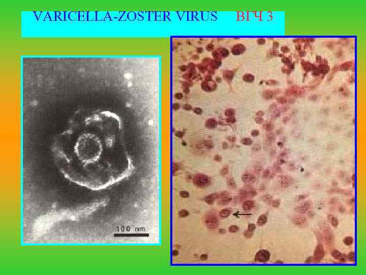 VARICELLA-ZOSTER VIRUS ВГЧ 3 