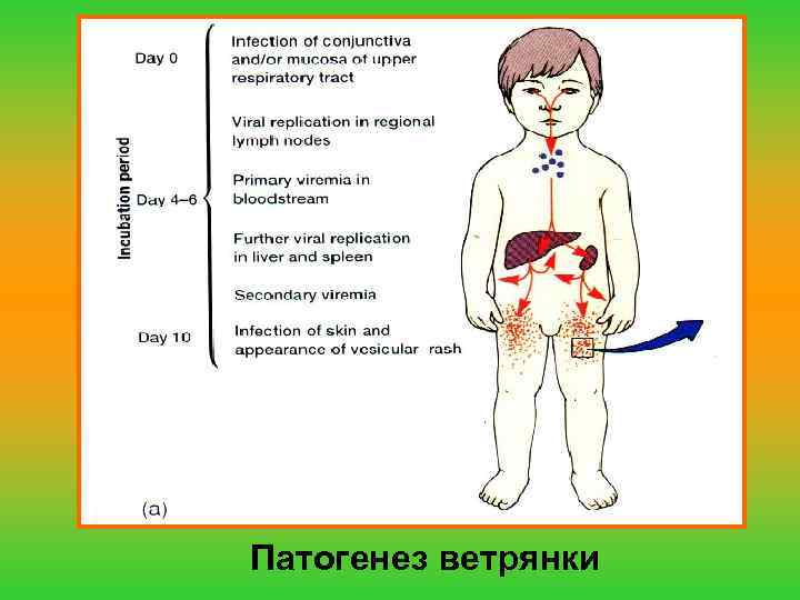 Патогенез ветрянки 
