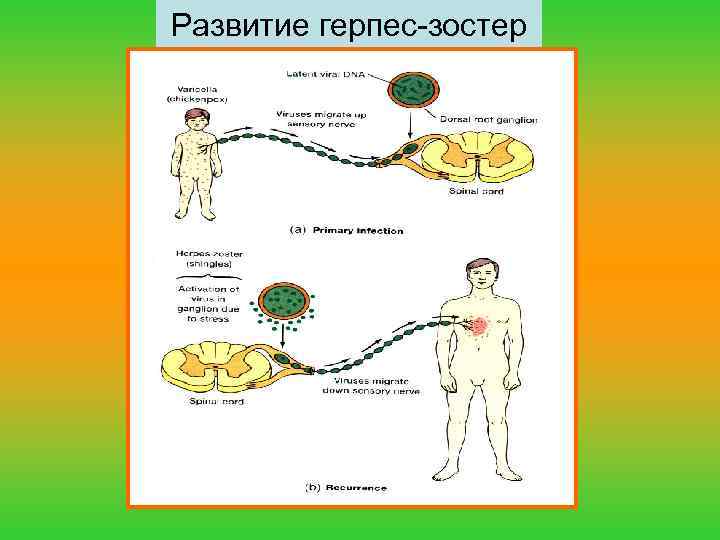 Развитие герпес-зостер 
