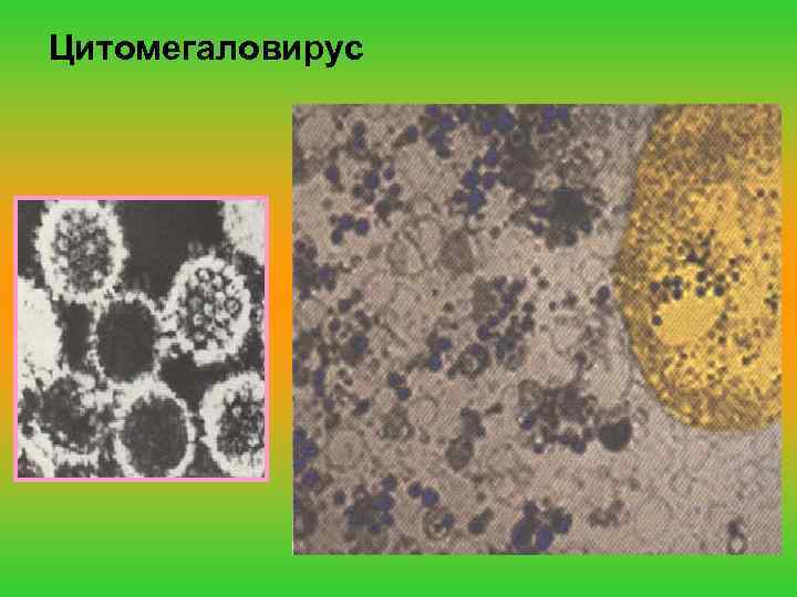 Цитомегаловирус 