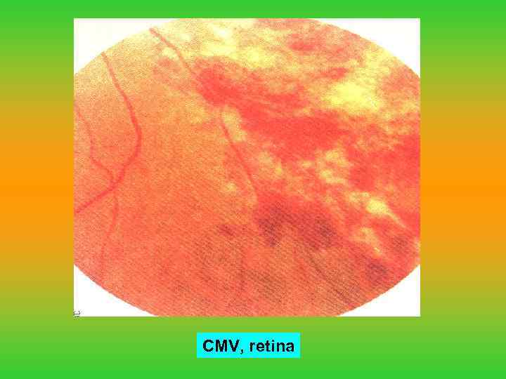 CMV, retina 