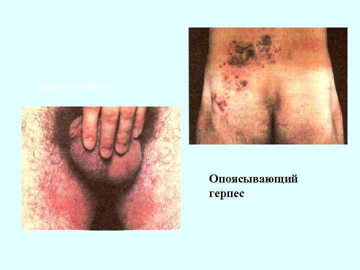 Дерматомікоз Опоясывающий герпес 