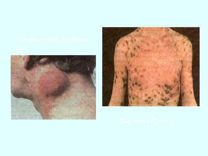 Позавузлова лімфома шиї Саркома Капоші 