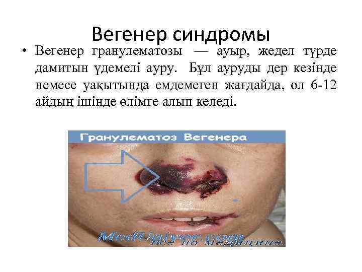 Вегенер синдромы • Вегенер гранулематозы — ауыр, жедел түрде дамитын үдемелі ауру. Бұл ауруды