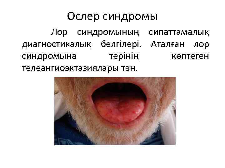 Ослер синдромы Лор синдромының сипаттамалық диагностикалық белгілері. Аталған лор синдромына терінің көптеген телеангиоэктазиялары тән.