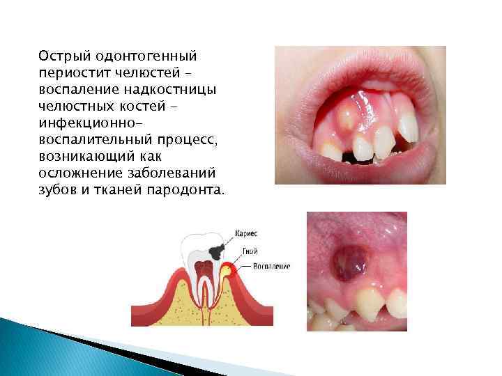 Острый одонтогенный периостит челюстей – воспаление надкостницы челюстных костей инфекционновоспалительный процесс, возникающий как осложнение