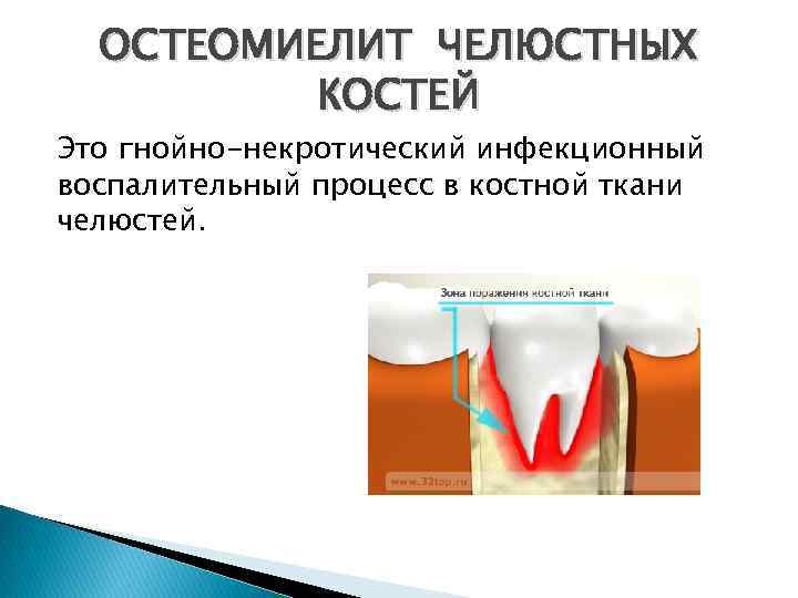 ОСТЕОМИЕЛИТ ЧЕЛЮСТНЫХ КОСТЕЙ Это гнойно-некротический инфекционный воспалительный процесс в костной ткани челюстей. 