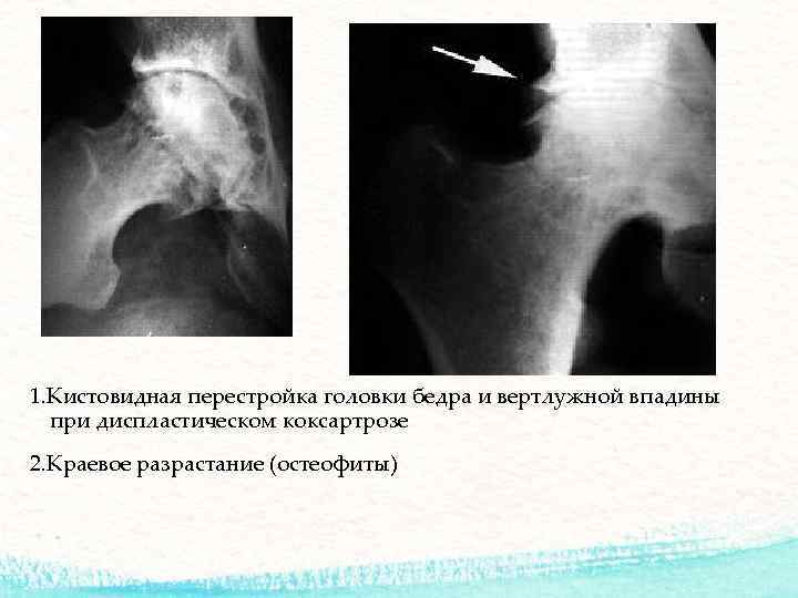 1. Кистовидная перестройка головки бедра и вертлужной впадины при диспластическом коксартрозе 2. Краевое разрастание