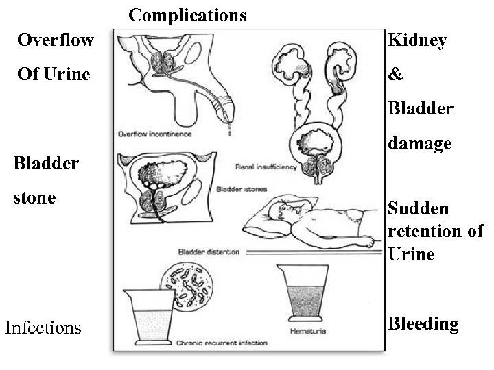Complications Overflow Kidney Of Urine & Bladder stone Infections damage Sudden retention of Urine