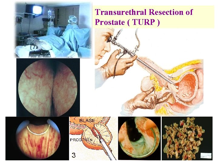 Transurethral Resection of Prostate ( TURP ) 