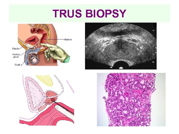 TRUS BIOPSY 