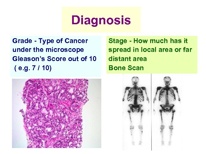 Diagnosis Grade - Type of Cancer under the microscope Gleason’s Score out of 10