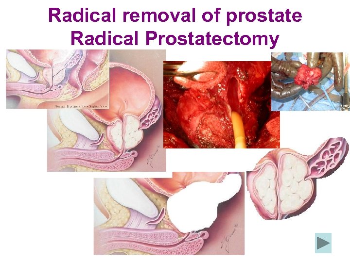 Radical removal of prostate Radical Prostatectomy 