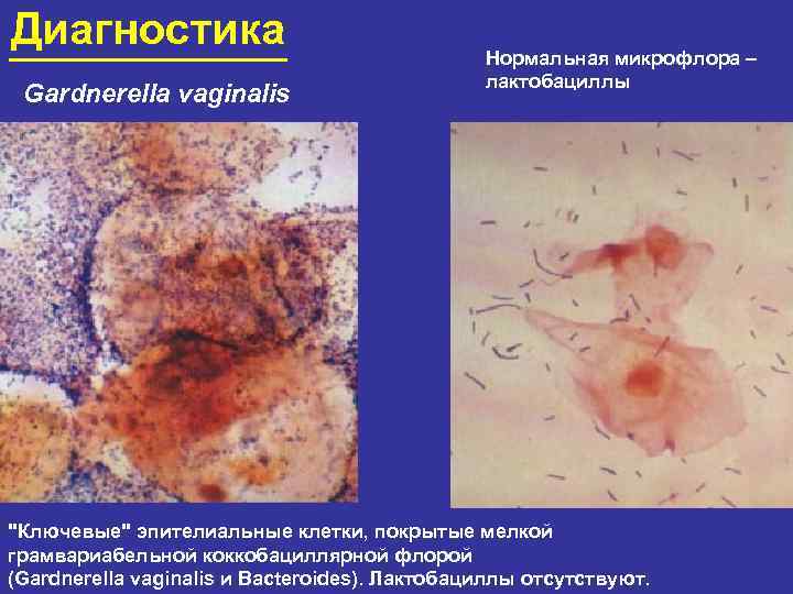 Диагностика Gardnerella vaginalis Нормальная микрофлора – лактобациллы 