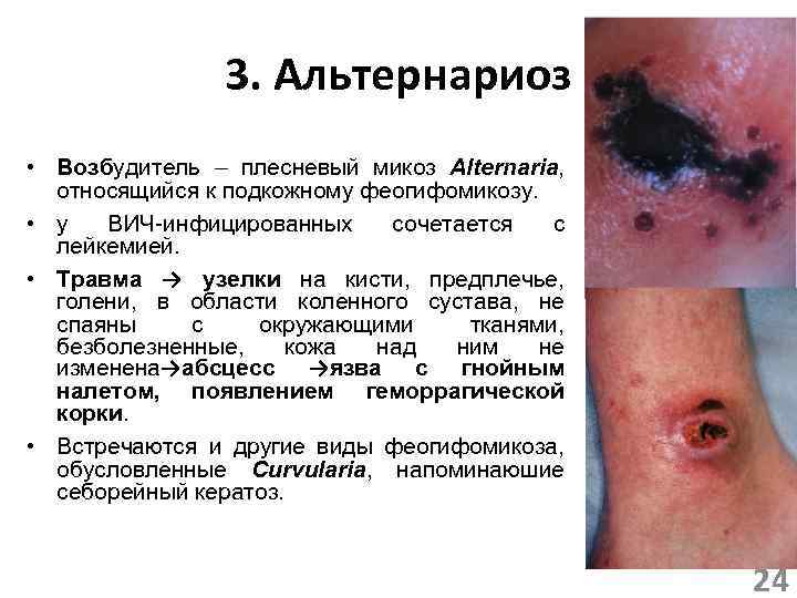 3. Альтернариоз • Возбудитель – плесневый микоз Alternaria, Воз относящийся к подкожному феогифомикозу. •