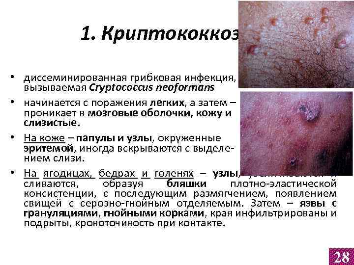 1. Криптококкоз • диссеминированная грибковая инфекция, вызываемая Cryptococcus neoformans • начинается с поражения легких,