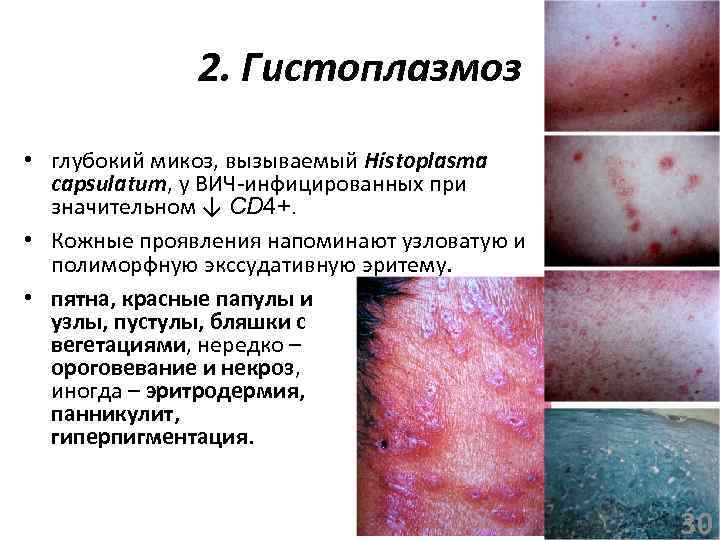 2. Гистоплазмоз • глубокий микоз, вызываемый Histoplasma capsulatum, у ВИЧ-инфицированных при значительном ↓ СD