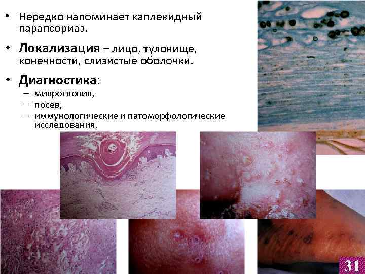  • Нередко напоминает каплевидный парапсориаз. • Локализация – лицо, туловище, конечности, слизистые оболочки.