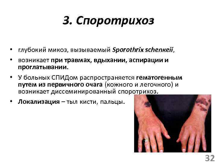 3. Споротрихоз • глубокий микоз, вызываемый Sporothrix schenкeii, • возникает при травмах, вдыхании, аспирации