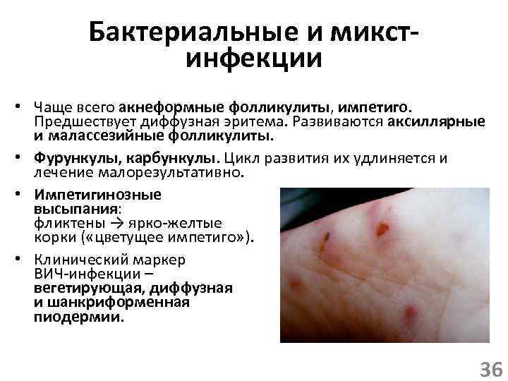 Бактериальные и микстинфекции • Чаще всего акнеформные фолликулиты, импетиго. Предшествует диффузная эритема. Развиваются аксиллярные