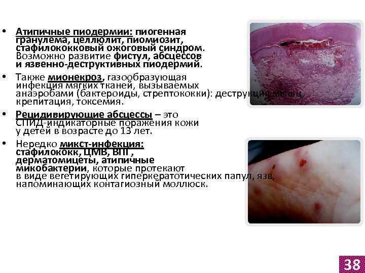  • Атипичные пиодермии: пиогенная гранулема, целлюлит, пиомиозит, стафилококковый ожоговый синдром. Возможно развитие фистул,