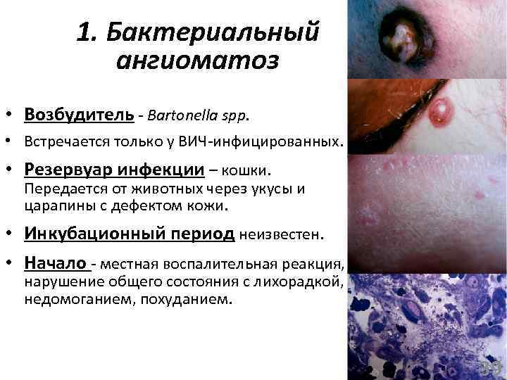 1. Бактериальный ангиоматоз • Возбудитель - Bartonella spp. • Встречается только у ВИЧ-инфицированных. •