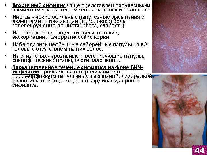  • Вторичный сифилис чаще представлен папулезными элементами, кератодермией на ладонях и подошвах. •