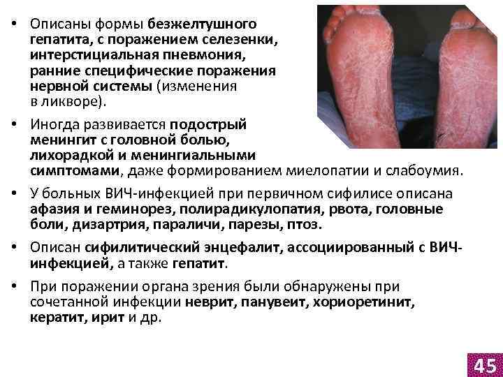  • Описаны формы безжелтушного гепатита, с поражением селезенки, интерстициальная пневмония, ранние специфические поражения