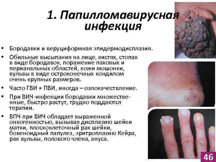 1. Папилломавирусная инфекция • Бородавки и веруциформная эпидермодисплазия. • Обильные высыпания на лице, кистях,