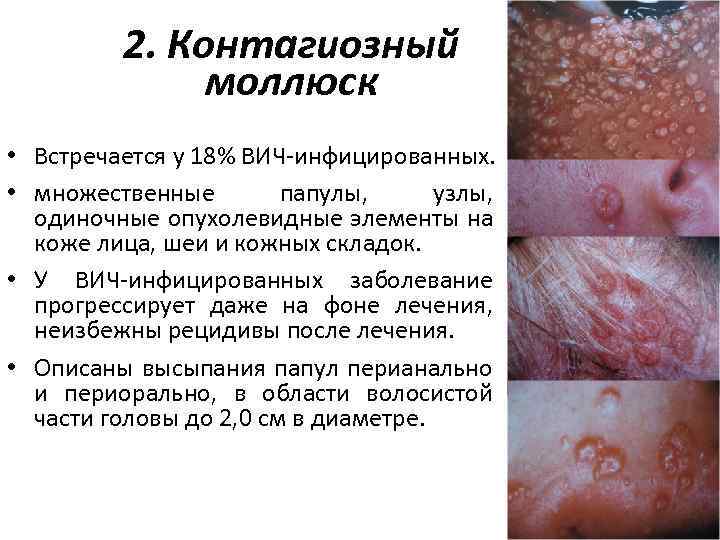 2. Контагиозный моллюск • Встречается у 18% ВИЧ-инфицированных. • множественные папулы, узлы, одиночные опухолевидные