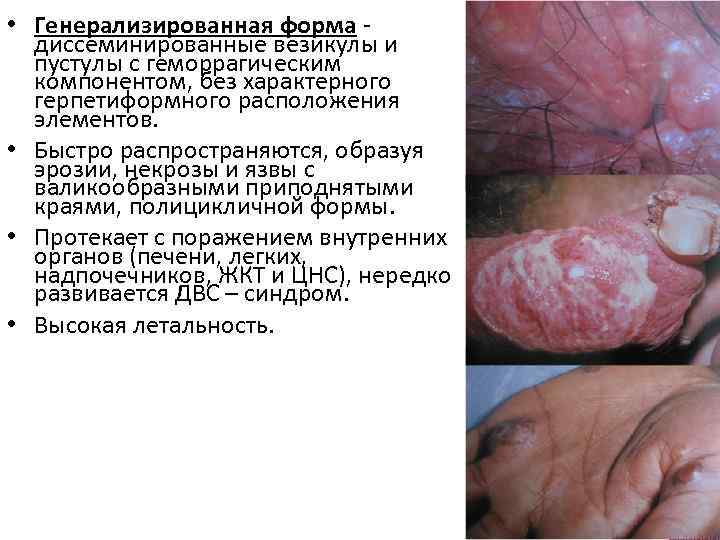  • Генерализированная форма диссеминированные везикулы и пустулы с геморрагическим компонентом, без характерного герпетиформного
