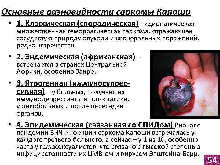 Основные разновидности саркомы Капоши • 1. Классическая (спорадическая) –идиопатическая множественная геморрагическая саркома, отражающая сосудистую