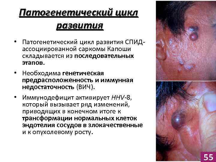 Патогенетический цикл развития • Патогенетический цикл развития СПИДассоциированной саркомы Капоши складывается из последовательных этапов.