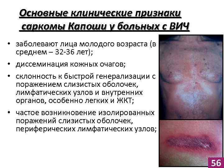 Основные клинические признаки саркомы Капоши у больных с ВИЧ • заболевают лица молодого возраста