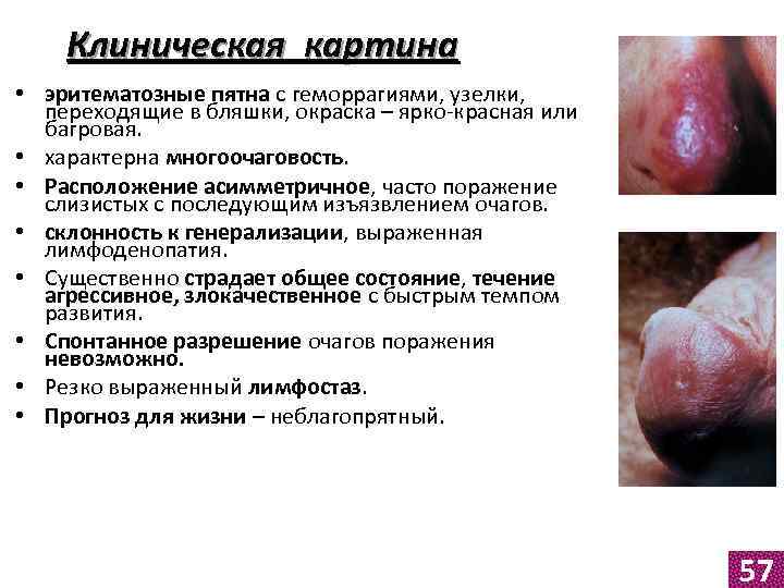 Клиническая картина • эритематозные пятна с геморрагиями, узелки, переходящие в бляшки, окраска – ярко-красная