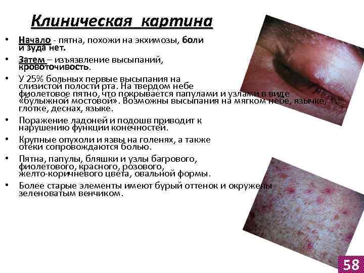 Клиническая картина • Начало - пятна, похожи на экхимозы, боли и зуда нет. •
