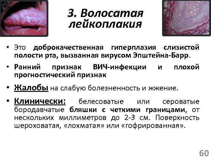 3. Волосатая лейкоплакия • Это доброкачественная гиперплазия слизистой полости рта, вызванная вирусом Эпштейна-Барр. •