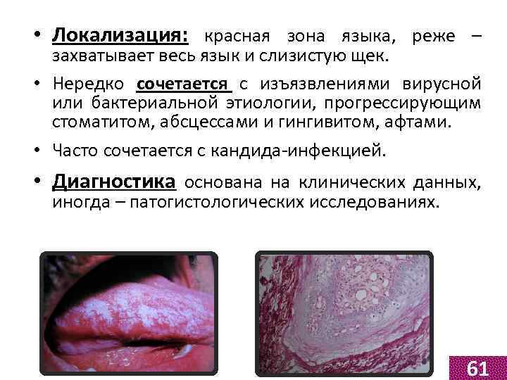  • Локализация: красная зона языка, реже – захватывает весь язык и слизистую щек.