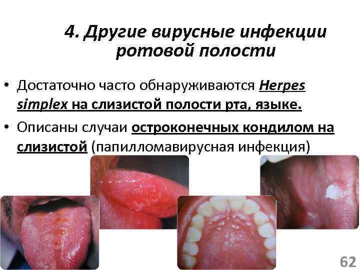 4. Другие вирусные инфекции ротовой полости • Достаточно часто обнаруживаются Herpes simplex на слизистой