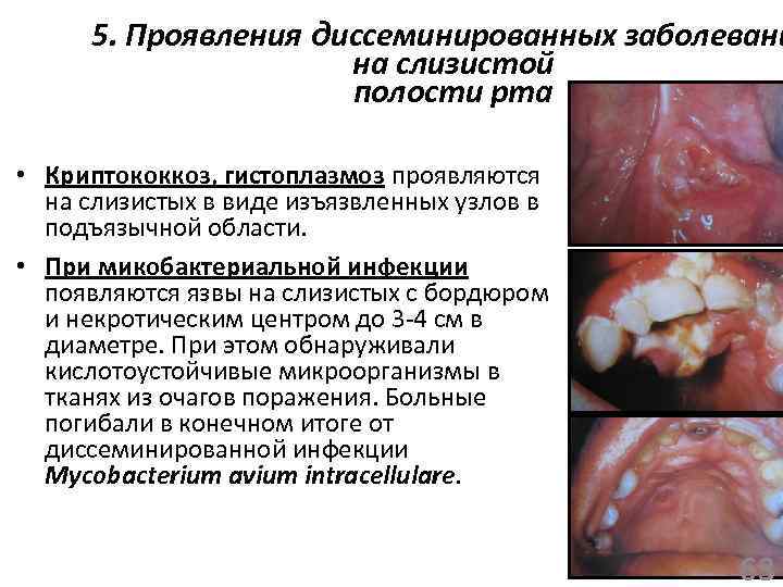 5. Проявления диссеминированных заболевани на слизистой полости рта • Криптококкоз, гистоплазмоз проявляются на слизистых