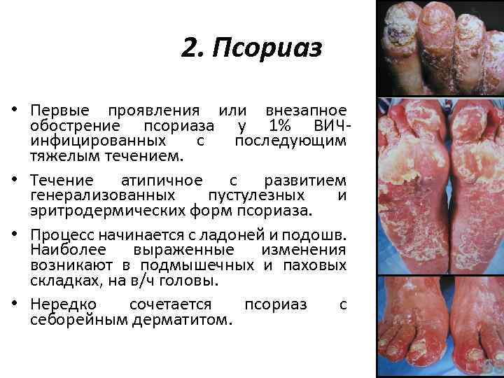 2. Псориаз • Первые проявления или внезапное обострение псориаза у 1% ВИЧинфицированных с последующим