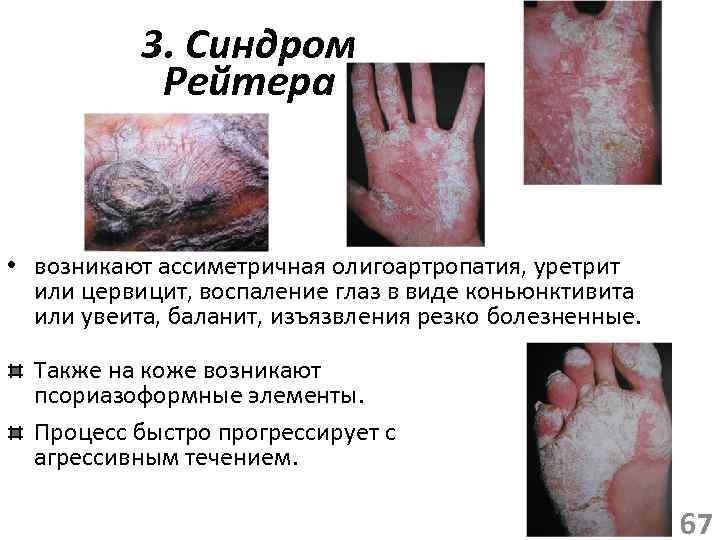 3. Синдром Рейтера • возникают ассиметричная олигоартропатия, уретрит или цервицит, воспаление глаз в виде