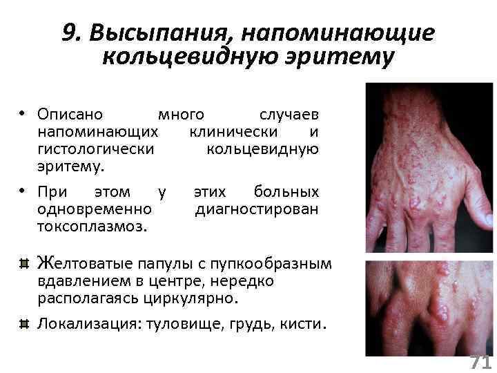 9. Высыпания, напоминающие кольцевидную эритему • Описано много случаев напоминающих клинически и гистологически кольцевидную