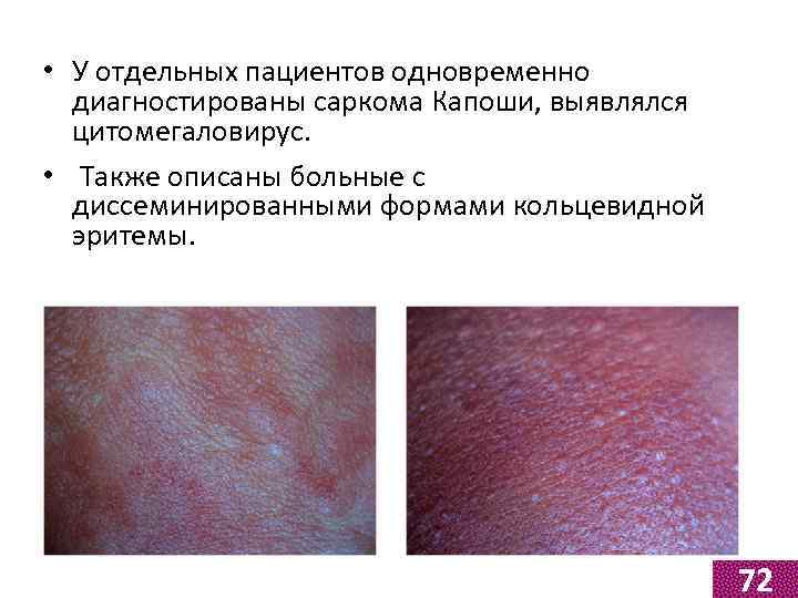  • У отдельных пациентов одновременно диагностированы саркома Капоши, выявлялся цитомегаловирус. • Также описаны