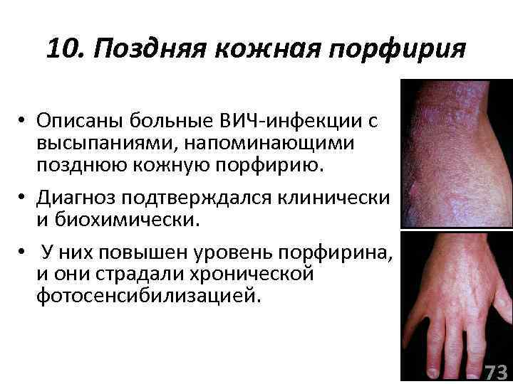 10. Поздняя кожная порфирия • Описаны больные ВИЧ-инфекции с высыпаниями, напоминающими позднюю кожную порфирию.