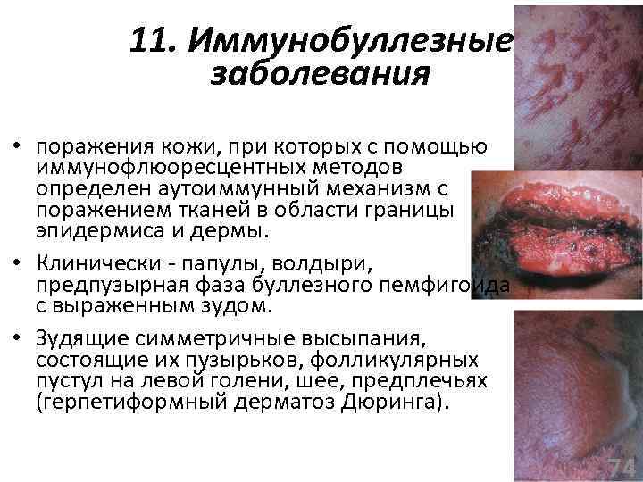 11. Иммунобуллезные заболевания • поражения кожи, при которых с помощью иммунофлюоресцентных методов определен аутоиммунный