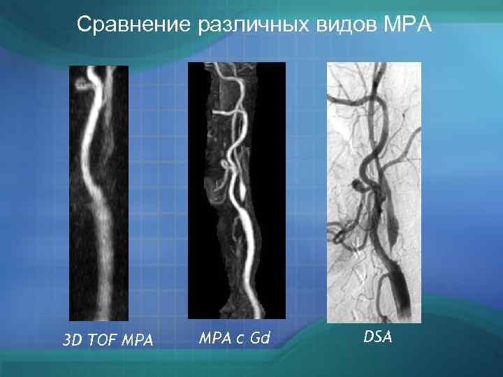 Сравнение различных видов МРА 3 D TOF МРА с Gd DSA 